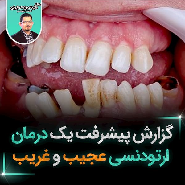 گزارش پیشرفت یک درمان ارتودنسی عجیب و غریب