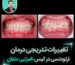 تغییرات تدریجی درمان ارتودنسی در کیس نامرتبی و دندان اضافه