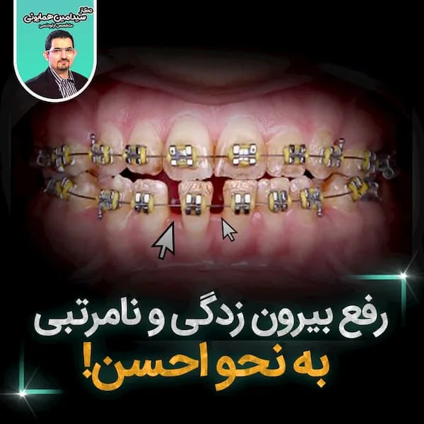 رفع بیرون زدگی و نامرتبی به نحو احسن!