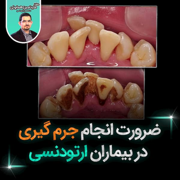 ضرورت انجام جرم گیری در بیماران ارتودنسی