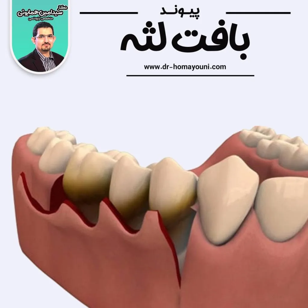 پیوند بافت لثه