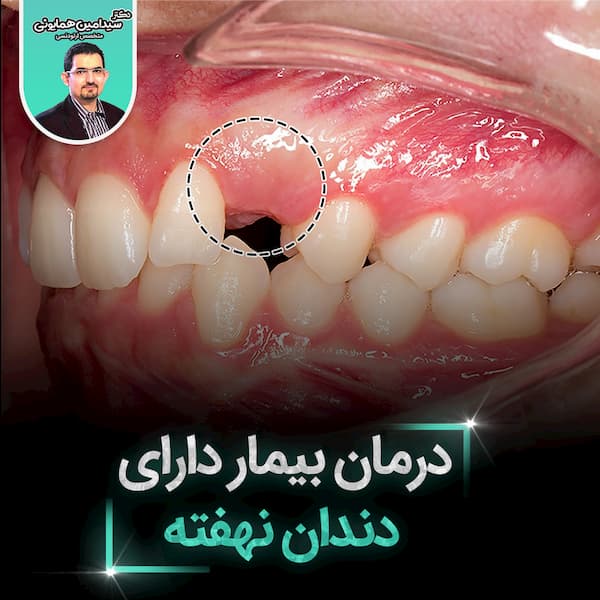 درمان بیمار دارای دندان نهفته