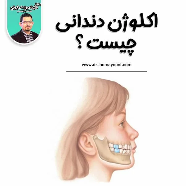 اکلوژن دندانی چیست؟ 1 اکلوژن دندانی چیست؟