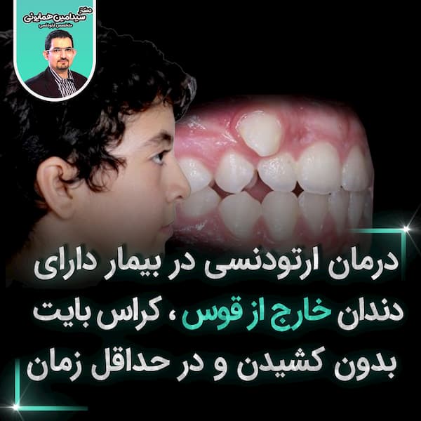 درمان ارتودنسی دربیمار دارای دندان خارج از قوس ، کراس بایت &#8230;.