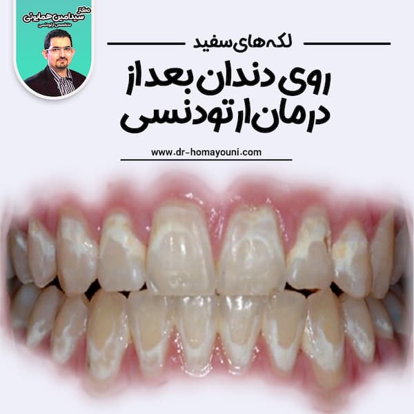 لکه های سفید روی دندان بعد از درمان ارتودنسی
