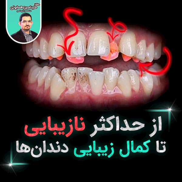 از حداکثر نازیبایی تا کمال زیبایی دندان‌ها  ..