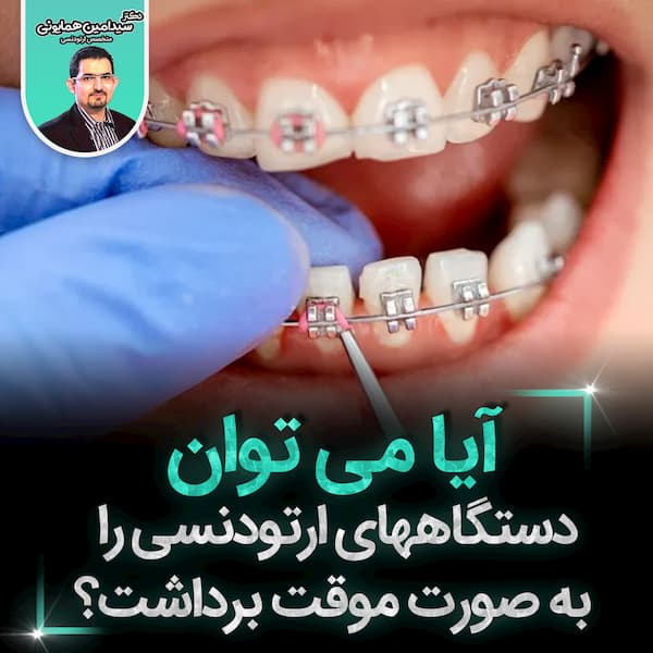 آیا می توان دستگاههای ارتودنسی به صورت موقت برداشت؟