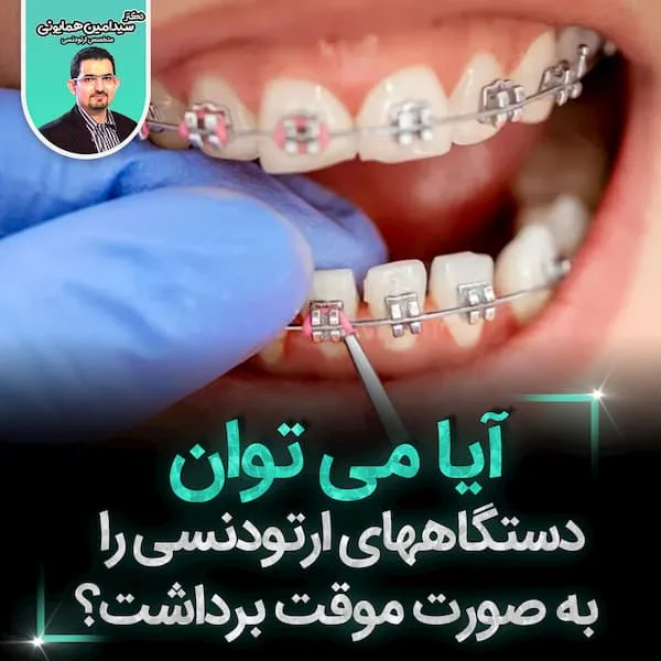 آیا می توان دستگاههای ارتودنسی به صورت موقت برداشت؟