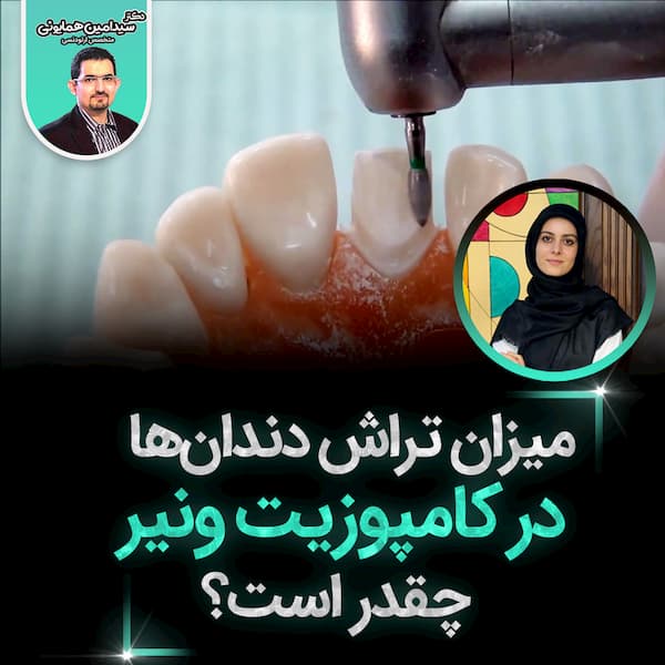 میزان تراش دندان_ها در کامپوزیت ونیر چقدر است؟2