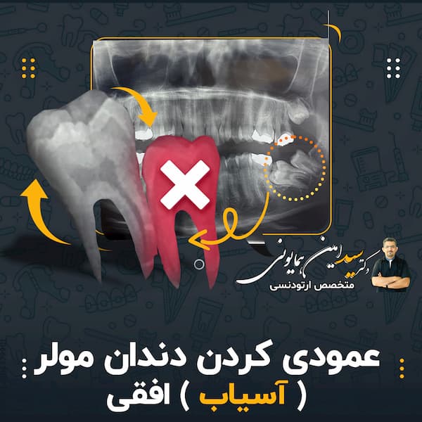عمودی کردن دندان مولر ( آسیاب ) افقی
