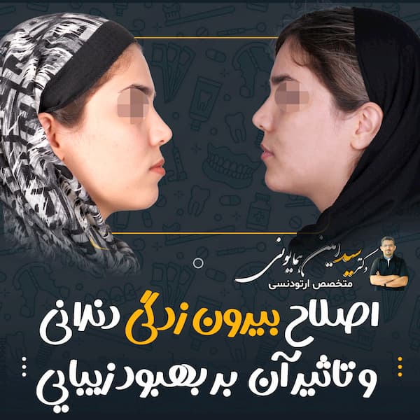 اصلاح بیرون زدگی دندانی و تاثیر آن بر بهبود زیبایی