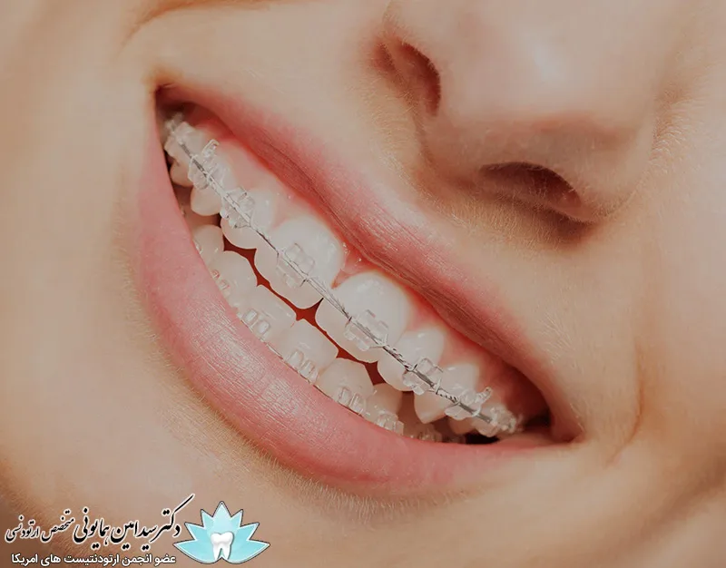 هزینه ارتودنسی سرامیکی 1 هزینه ارتودنسی سرامیکی