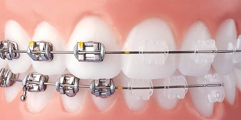 ارتودنسی سرامیکی بهتر است یا فلزی؟ 1 ارتودنسی سرامیکی بهتر است یا فلزی؟