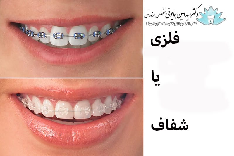 ارتودنسی شفاف؟ درمان و زیبایی 1 ارتودنسی شفاف؟ درمان و زیبایی