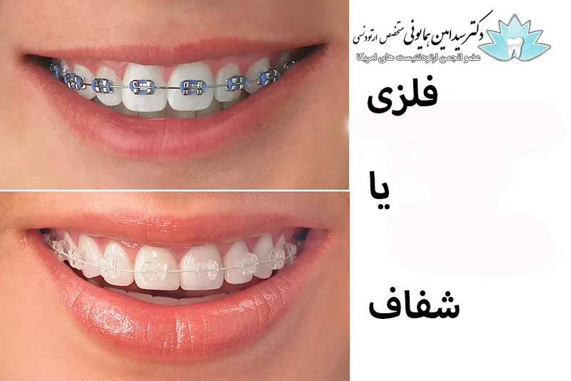 ارتودنسی شفاف؟ درمان و زیبایی 1 ارتودنسی شفاف؟ درمان و زیبایی