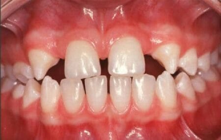 دلایل نیاز به ارتودنسی در کودکان 2 درمان ارتودنسی بیماران فاقد دندان ثنایای کناری