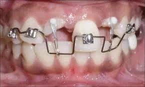 فورس اراپشن ارتودنسی 1 photo17980327993