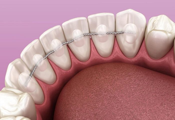 استفاده از ریتینر در صورت از دست رفتن دندان و پس از ایمپلنت 1 fixed orthodontic retainer 700x480 1