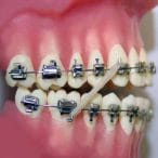 الاستیک ارتودنسی چیست؟ 1 Elastics