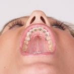 آیا ارتودنسی لینگوال، جایگزین ارتودنسی ثابت میشود 1 ارتودنسی لینگوال