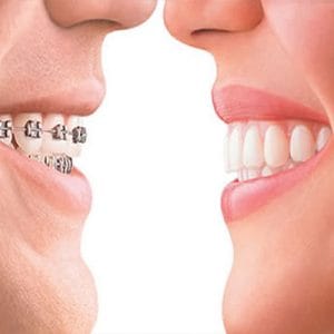 ارتودنسی نامرئی 2 ارتودنسی نامرئی